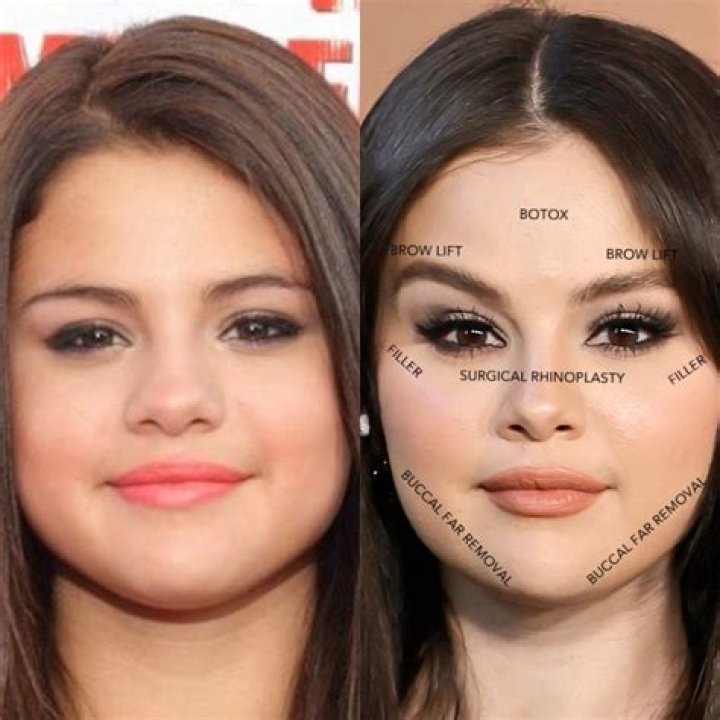 From Natural Beauty To Glamour: The Transformative Journey Of An Actress Before And After Plastic Surgery