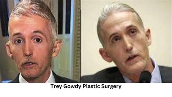 Unveiling The Truth Behind Trey Gowdy's Plastic Surgery Rumors